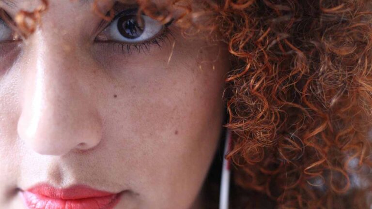Melasma: Doença crônica causada pela exposição solar tem tratamento