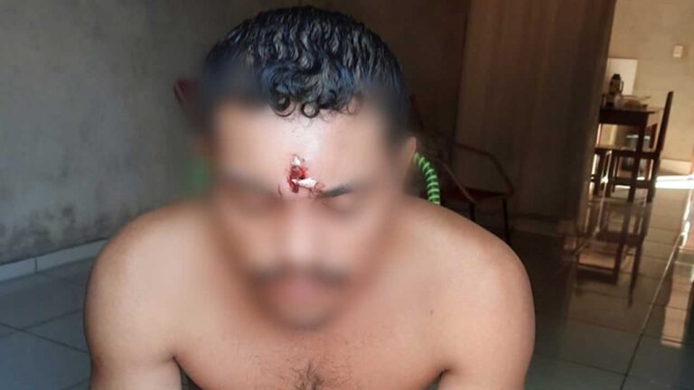 Homem leva tiro na testa, perde massa encefálica e vai para casa dormir
