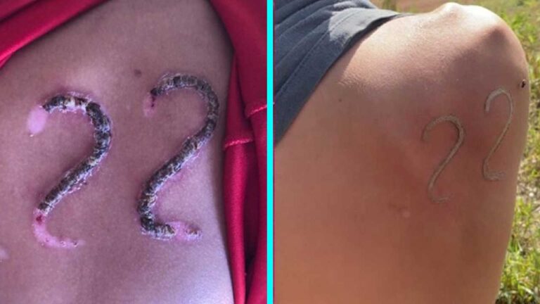 Adolescente é desafiado e marca número de Bolsonaro na pele com ferro em brasa