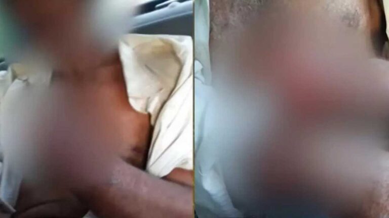 Fazendeiro não paga salário de funcionário e decepa a mão dele após furto de galinha