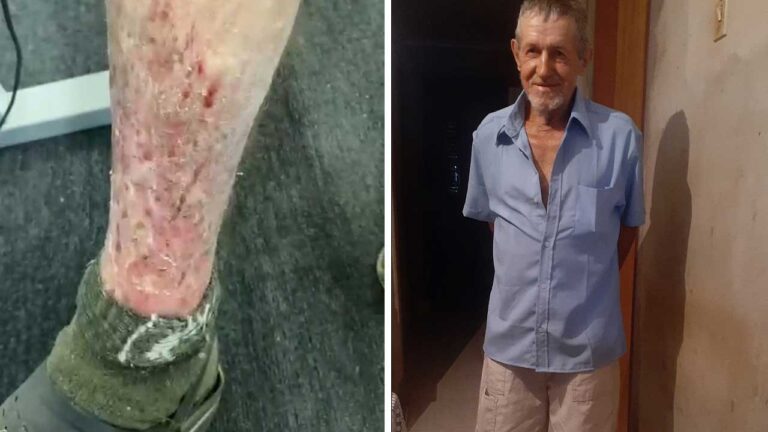 Comunidade cria campanha para ajudar idoso que corre risco de amputar uma das pernas em João Pinheiro