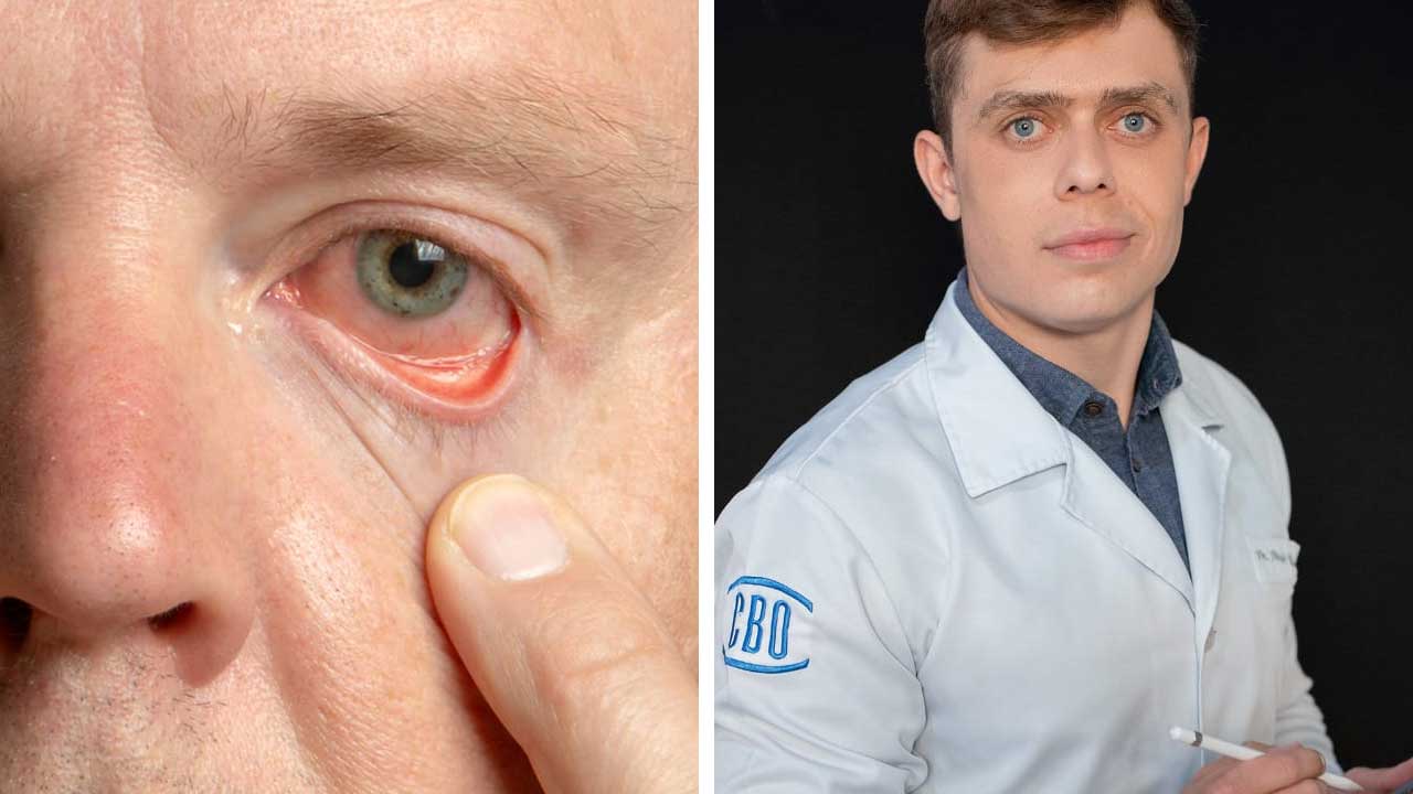 Síndrome do olho seco em João Pinheiro: Como o ar seco está afetando sua saúde ocular