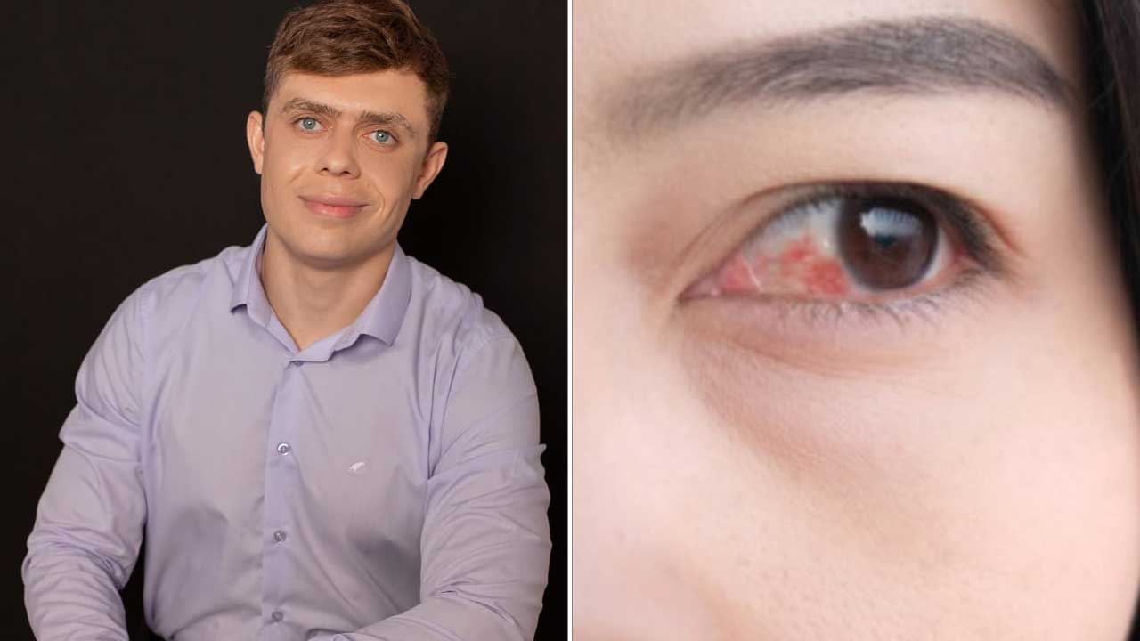 Conjuntivite em foco: oftalmologista de João Pinheiro explica sintomas e cuidados
