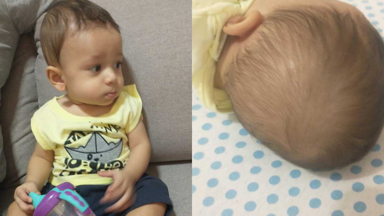 Família de bebê de 9 meses com deformidade craniana pede ajuda para órtese em João Pinheiro