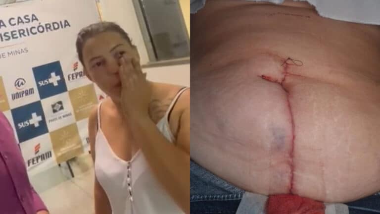 Mulher vai ao hospital para fazer biópsia e sai com a barriga cortada; Santa Casa nega erro médico