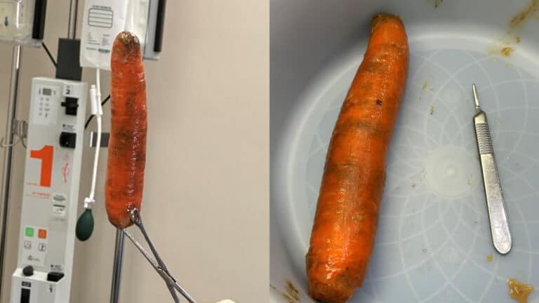 Homem vai parar no hospital após ficar com cenoura gigante presa no ânus; médico faz alerta nas redes sociais