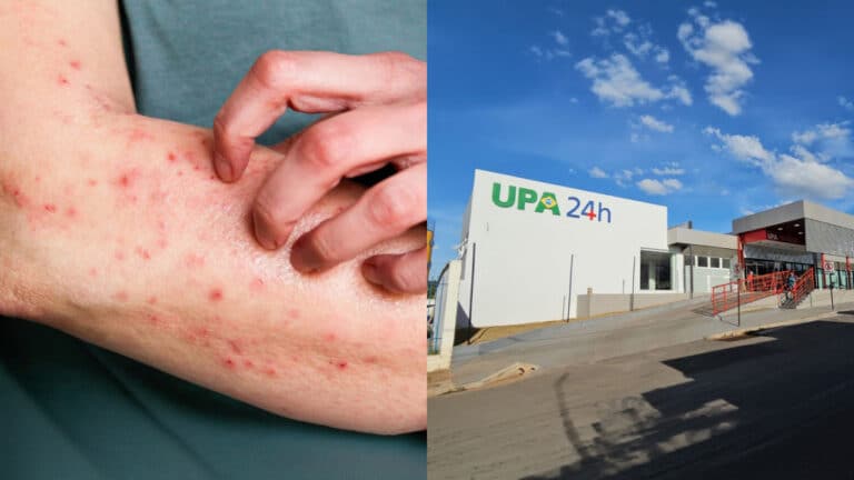Resultado negativo: caso suspeito de Mpox é descartado e Patos de Minas segue sem registro da doença