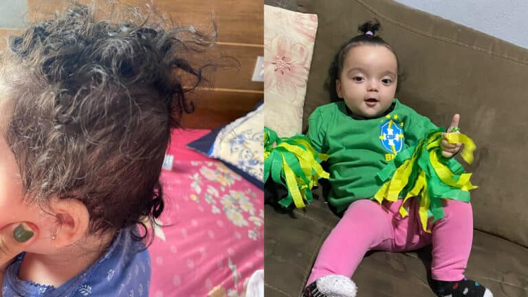 Helena, bebê de 7 meses, precisa de tratamento urgente após diagnóstico de braquicefalia em João Pinheiro