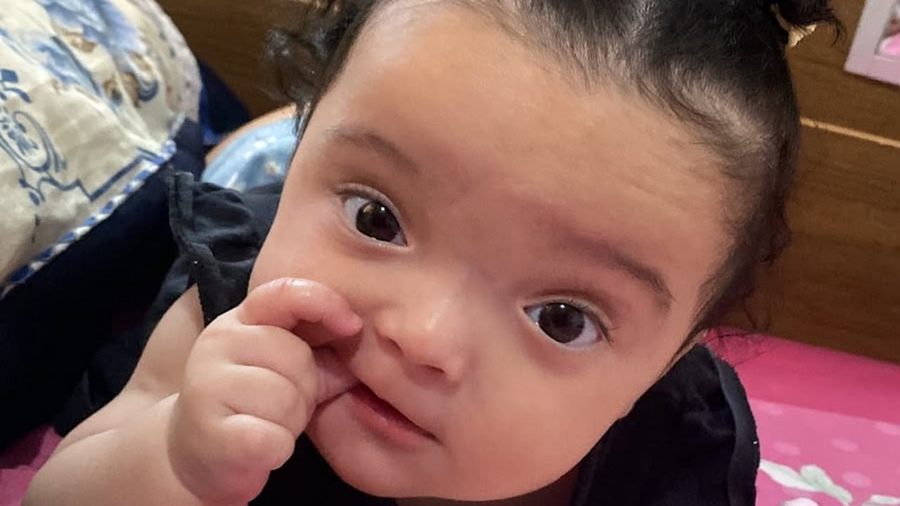Helena, bebê de 7 meses, precisa de tratamento urgente após diagnóstico de braquicefalia em João Pinheiro
